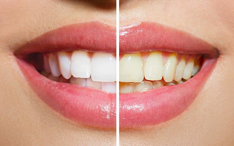 A satisfied patient with a radiant, white smile, symbolizing the confidence boost from effective teeth whitening Gloucester