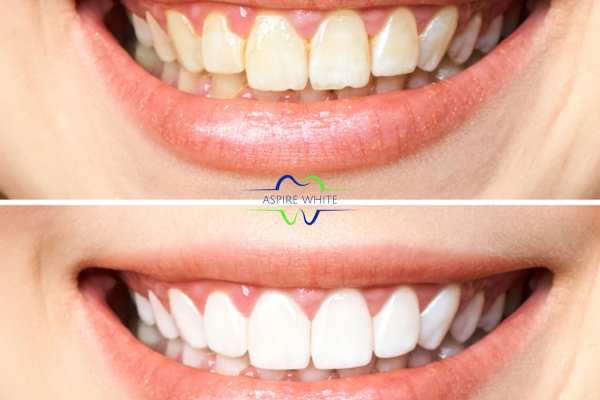 Fast results whitening