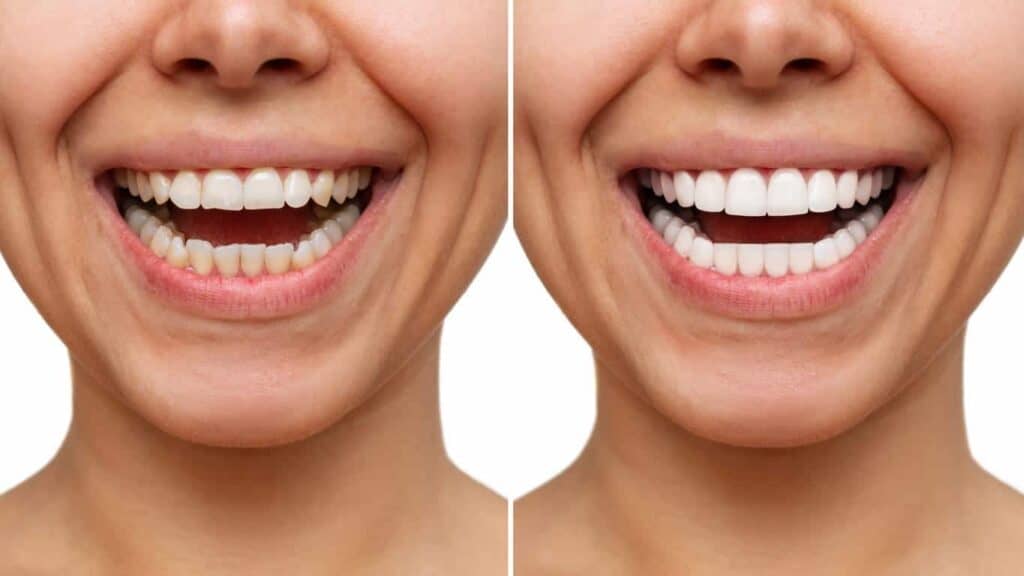 Contact Aspire White for teeth whitening services – Get in touch with Gloucester today