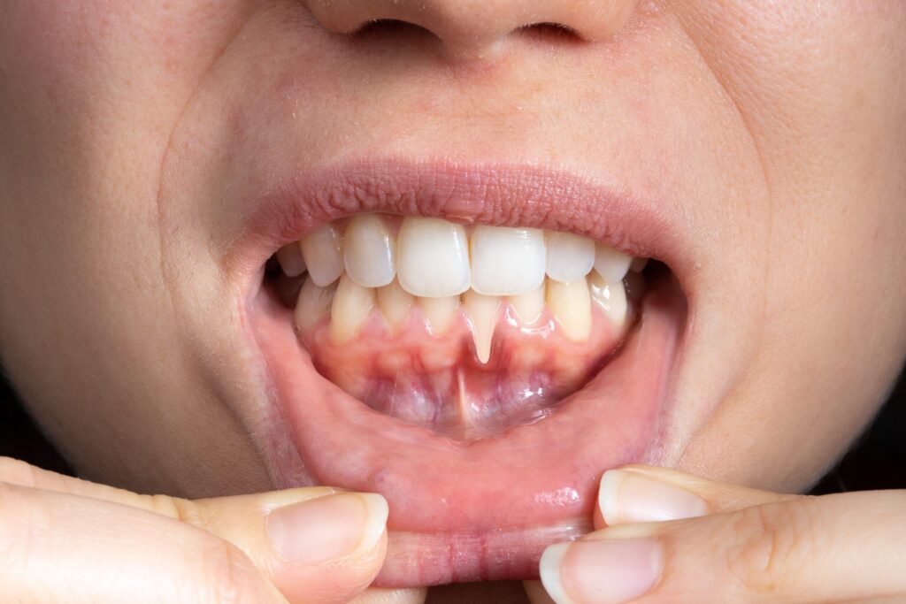 Preparing for teeth whitening with receding gums Gloucester