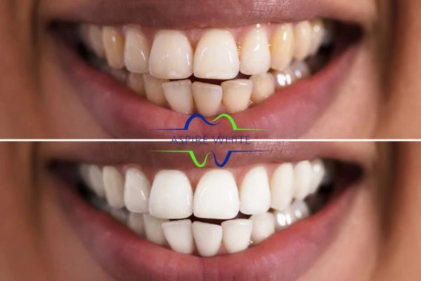 Aspire White customer before and after Gloucester results.