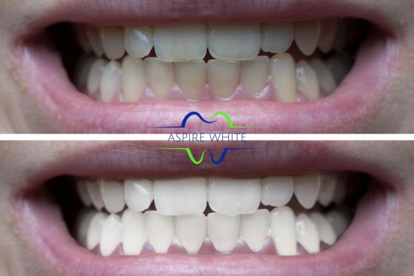 1 hour laser teeth whitening before and after results Gloucester