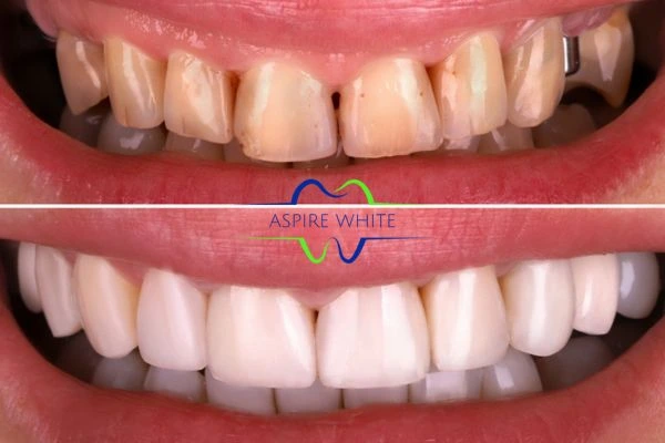 Yellow teeth results - 1 hour whitening before and after results Gloucester