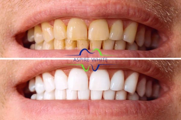 Get noticeable whiter smile in just one hour! Book your teeth whitening treatment Gloucester today!