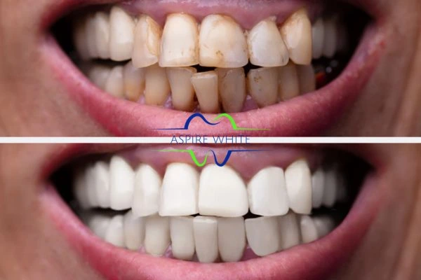 Before and after results of laser teeth whitening Gloucester Book in online today!