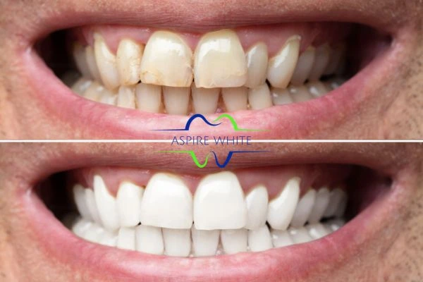 Achieve a radiant smile with professional laser teeth whitening Gloucester